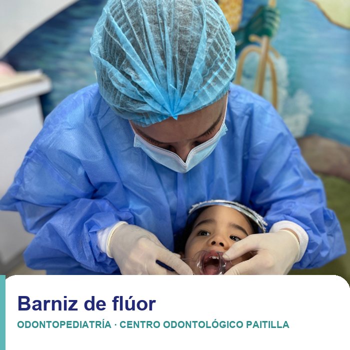 Barniz de flúor para niños